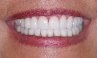 Smile makeover after 372754