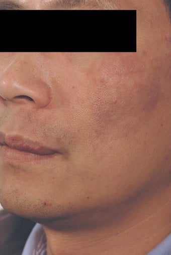 Port Wine Birthmark Removal after 502725
