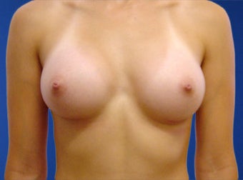 Silicone Breast Augmentation after 239076