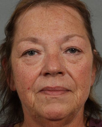 Radiesse & Juvederm before 373933