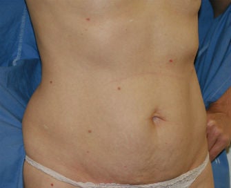 Mini-abdominoplasty 493674