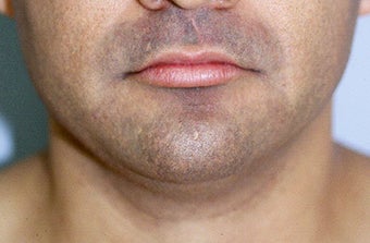 Neck Liposuction before 68523