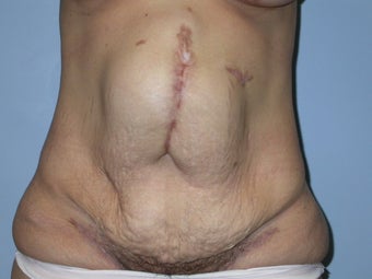 Abdominoplasty and Hernia Repair before 117248