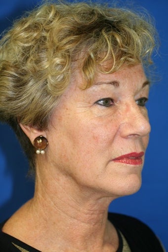 Facelift before 131638
