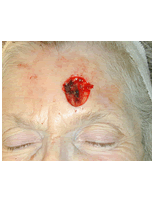 Skin cancer reconstruction before 84494