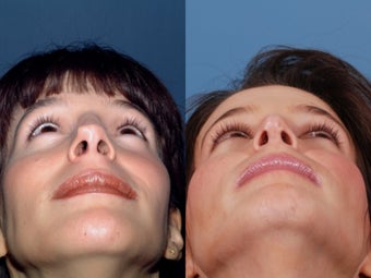 Revision rhinoplasty 437931