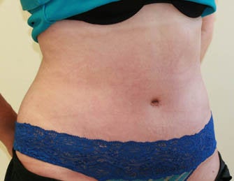 Abdominoplasty (Tummy Tuck) after 216685