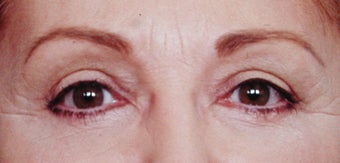 Blepharoplasty after 287437