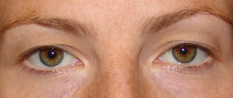 Upper Eyelid Blepharoplasty before 356800