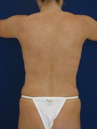 Vaser Hi Def Liposuction of chest, abdomen, back and flanks before 422725