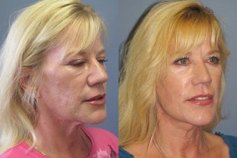 Lite Lift™, neck lift before 523722