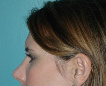 Rhinoplasty after 118337