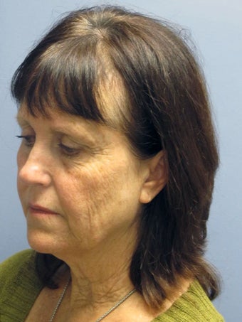 Neck Lift, Platysmaplasty 634720