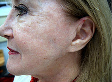 Fractional C02 laser after 533646
