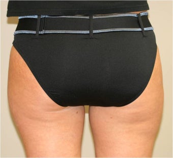 Smart Lipo Saddlebags (moderate) Posterior View after 109416