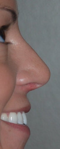 Rhinoplasty - Hump Reduction, Lift Drooping Tip after 134439