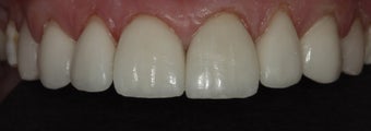 Porcelain Veneers and Crowns after 485383
