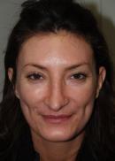 Rhinoplasty before 333808