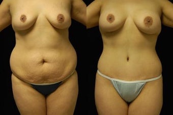 Tummy Tuck and Breast Augmentation- gel implants before 392664