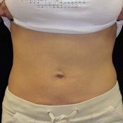 Thermage Abdomen after 213721