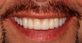 Full Mouth Reconstruction 345554