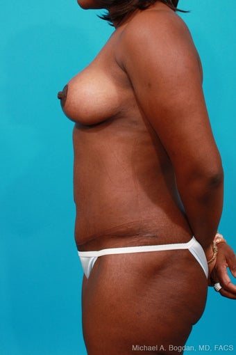 Mommy Makeover: Breast Lift & Extended Abdominoplasty after 252327
