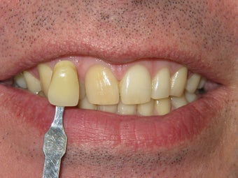 Whitening bleach trays before 348012