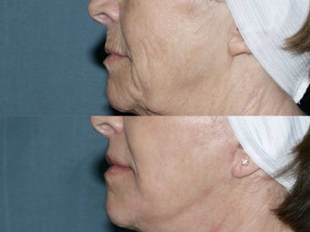 Face and Neck Fraxel repair with C02/Erbium lasers for upper lip wrinkles before 104645