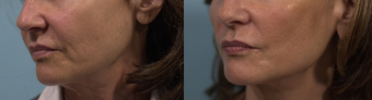 Mini Facelift after 303635