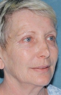 Laser resurfacing treatment for wrinkles 376154