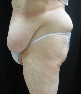 Abdominoplasty (tummy tuck) before 263037