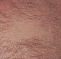 Los Angeles Tattoo Removal after 151339