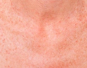 IPL Treatment for Chest after 374398