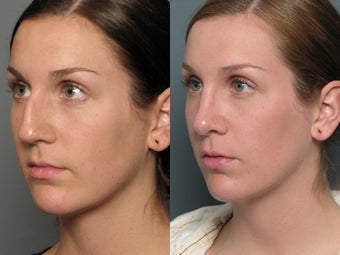 Nose Surgery after 338481