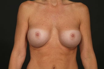 Breast Augmentation after 291229