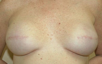 Breast Reconstruction 526305