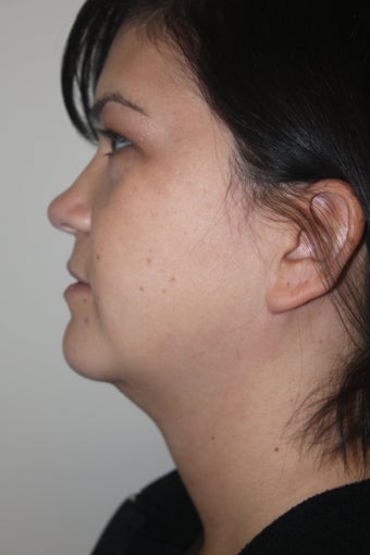 SmartLipo to the neck before 526873
