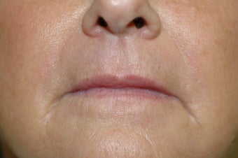 Hetter facial resurfacing after 434878