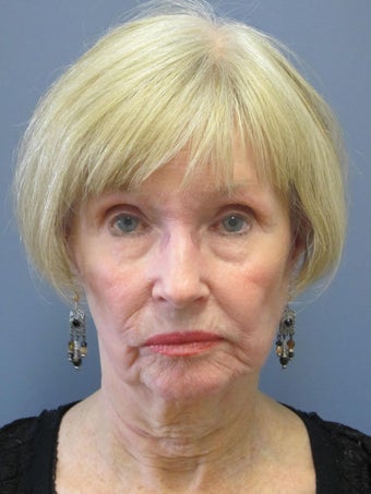 Neck Lift, Platysmaplasty before 634745