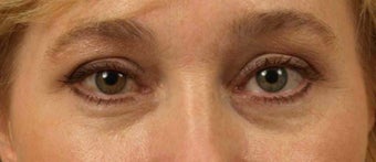 Lower Eyelid/Tear-Trough Restyalne before 467136