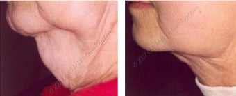 Lipodissolve before and after on chin before 9741