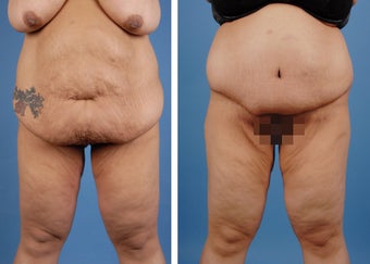 Lower Body Lift and Extended Tummy Tuck before 335991