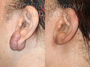 Keloid Removal before 613877