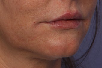 Perlane L to Lips 309740