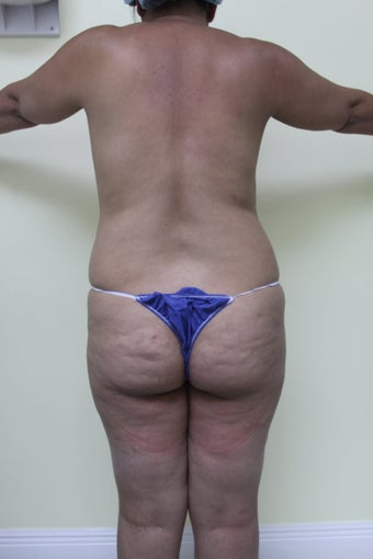 Brazilian butt lift before 360221