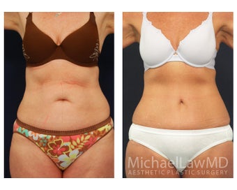 Abdominoplasty - Tummy Tuck before 396080