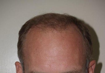 Hair Transplant / 2000 grafts after 222911