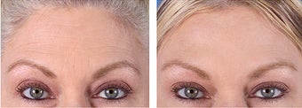Botox Cosmetic before 253589