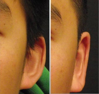 Ear Surgery - Otoplasty before 468319