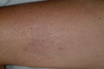 Sclerotherapy after 95916